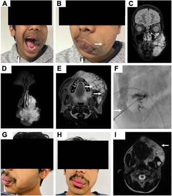 Multicentered analysis of percutaneous sclerotherapies in venous malformations of the face